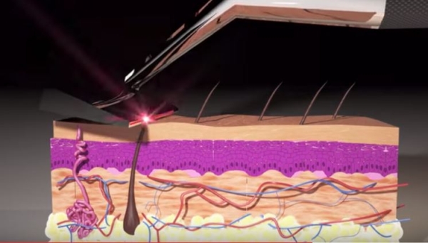 Laser-Rasierer schneidet Haare mit Licht