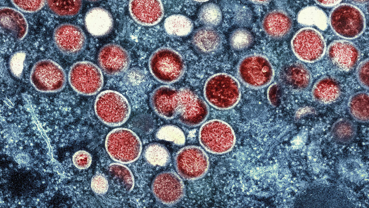 Höchste Alarmstufe wegen Mpox-Virus - was bedeutet das?